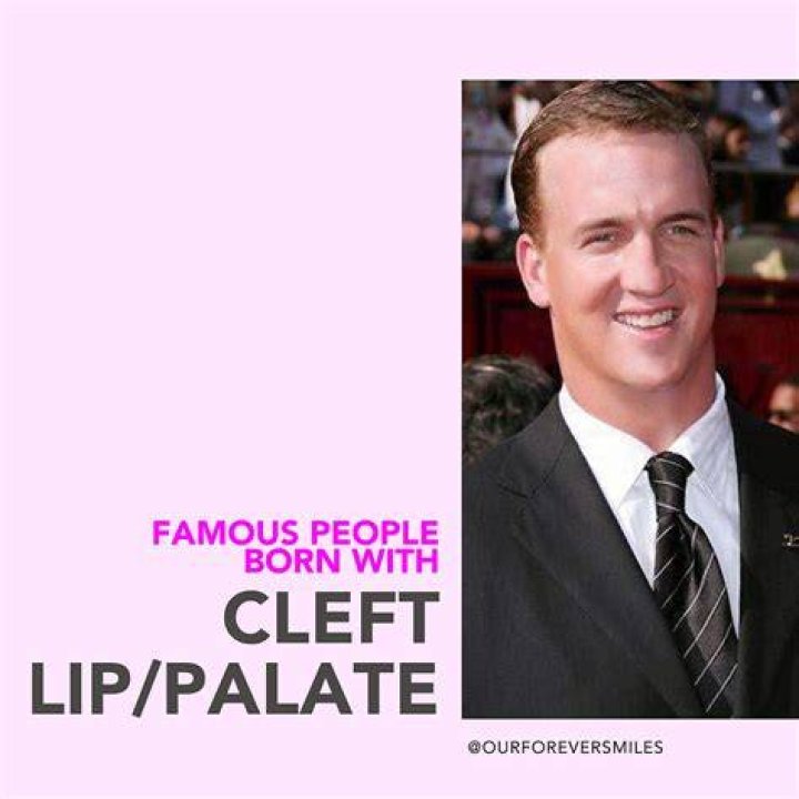 Famous Celebrities Born With Cleft Lips