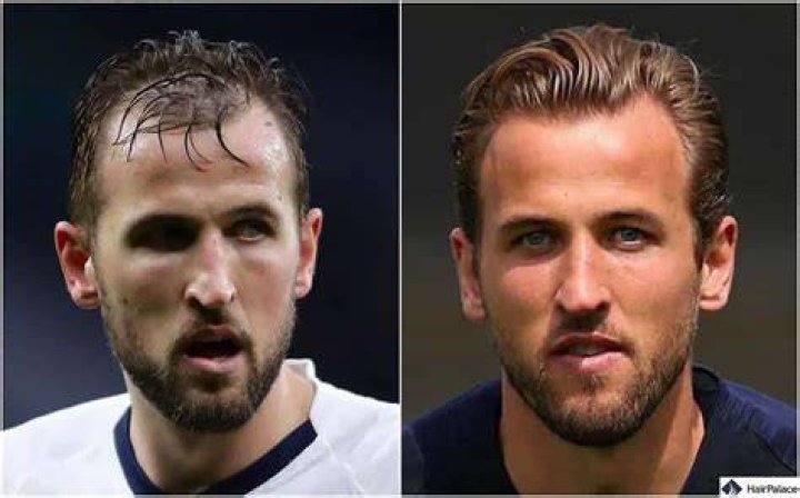 Harry Kane Hair Transplant How Much did It Cost?