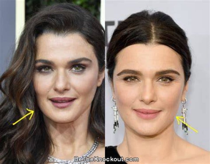 Rachel Weisz Facelift Plastic Surgery Before and After Celebie